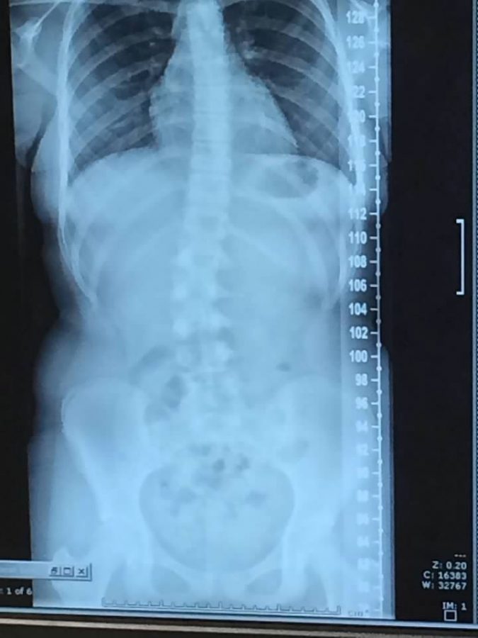 X-Ray of my spine from November 2018. 